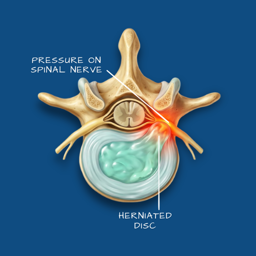 Disc Herniation