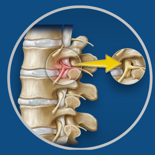 Foraminotomy