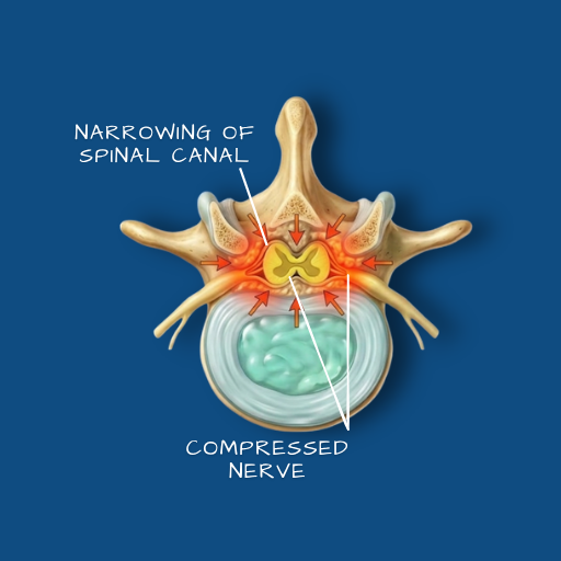 Spinal Stenosis