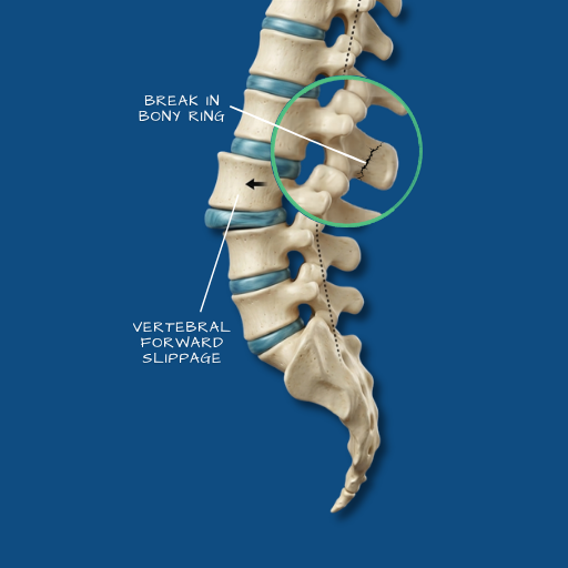 Spondylolisthesis