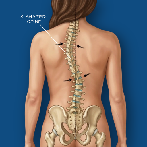 Spinal Deformity / Scoliosis