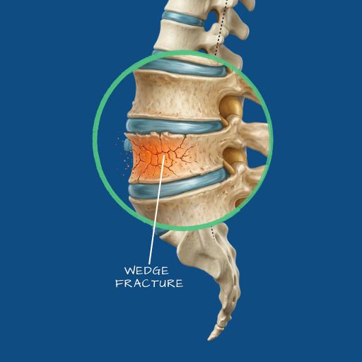 Vertebral Fractures