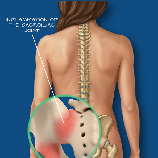 Sacroiliac Joint Dysfunction