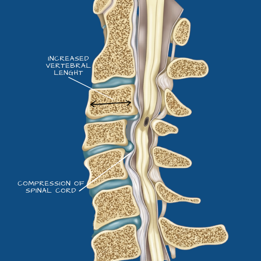 Cervical Disc Disease