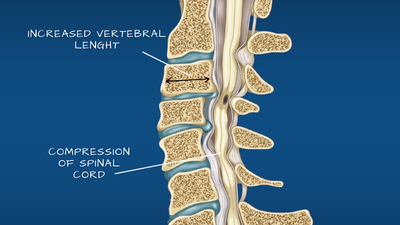 Cervical disc disease neck pain illustration