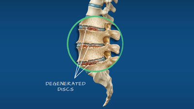 Degenerative disc disease spine illustration