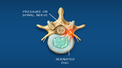 Disc herniation slip disc illustration