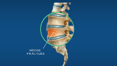 Vertebral fracture spine illustration