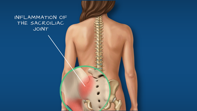 Sacroiliac joint dysfunction illustration