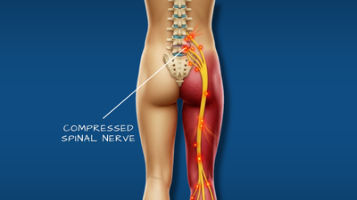 Sciatica nerve pain lower back to leg illustration
