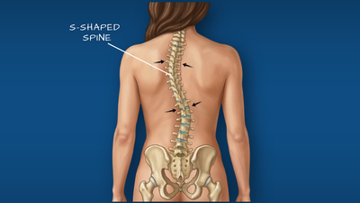 Spinal deformity scoliosis illustration