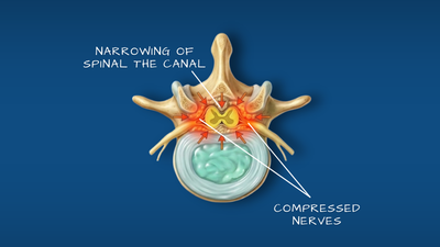 Spinal stenosis narrowed canal illustration
