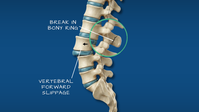 Spondylolisthesis vertebral slip illustration